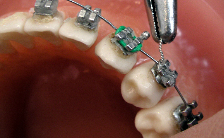 Tratamientos de Ortodoncia en Jaén en Espacio Dental Jaén