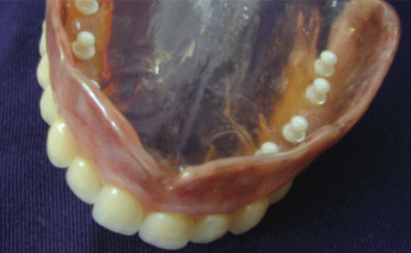 Prótesis completa superior con anclajes 3 - Espacio Dental Jaén Prótesis completa superior con anclajes 3 - Espacio Dental Jaén