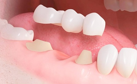 Endodoncia en Jaén en Espacio Dental Jaén