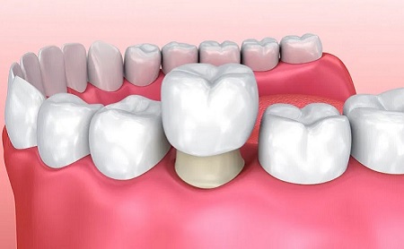 Endodoncia en Jaén en Espacio Dental Jaén
