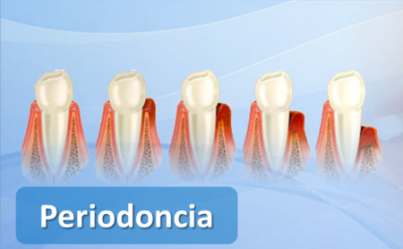 Periodoncia en Jaén en Espacio Dental Jaén